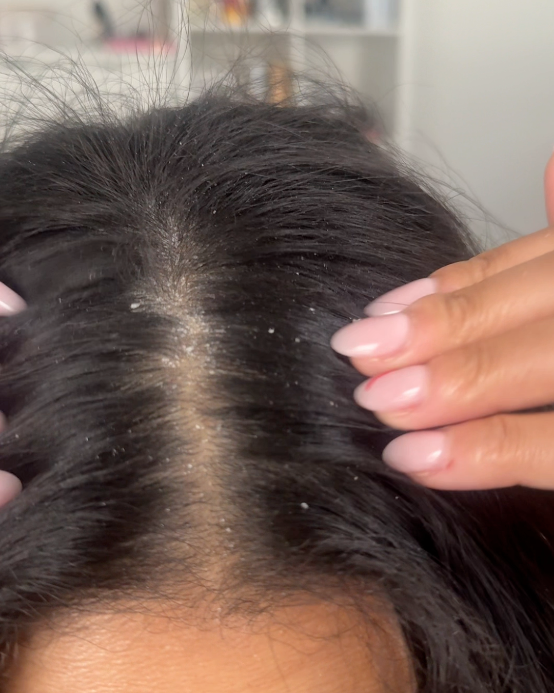 Dry Scalp Relief